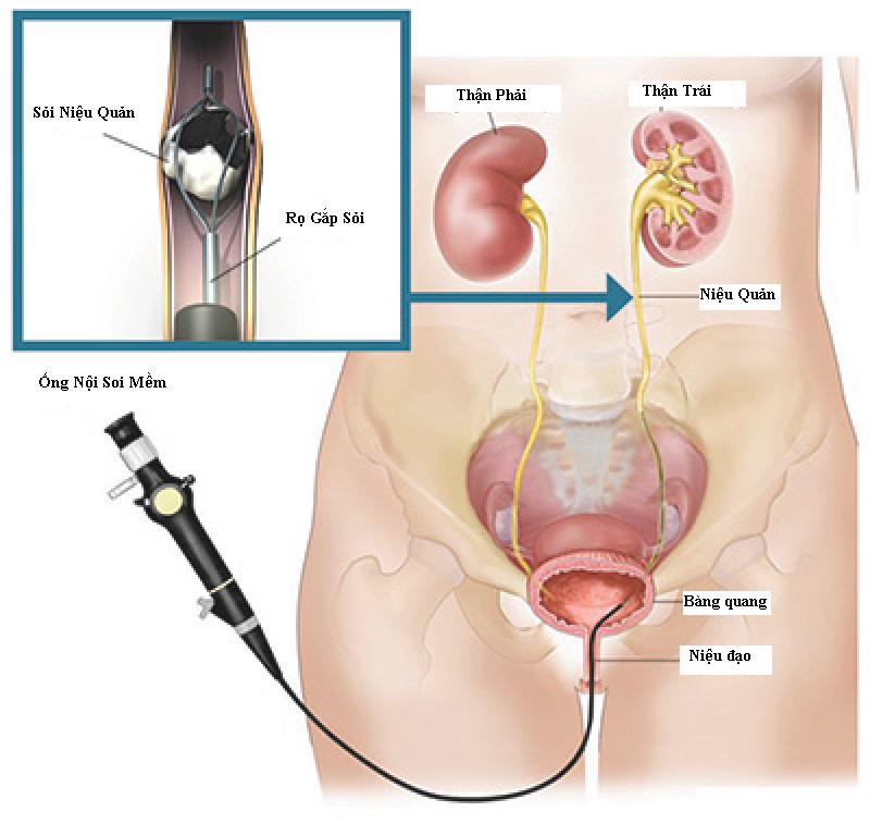 Các phương pháp điều trị sỏi thận